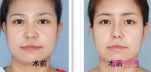 隆鼻手术的费用是多少呢?
