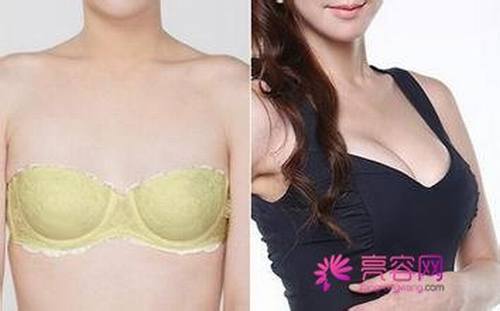 假体隆胸的费用是多少呢?