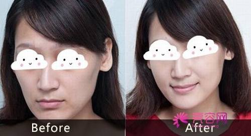 自体脂肪丰苹果肌的费用是多少呢