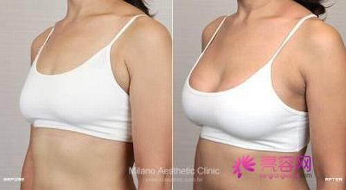 乳房下垂矫正多少钱