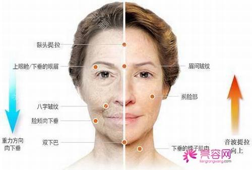 面部除皱多少钱