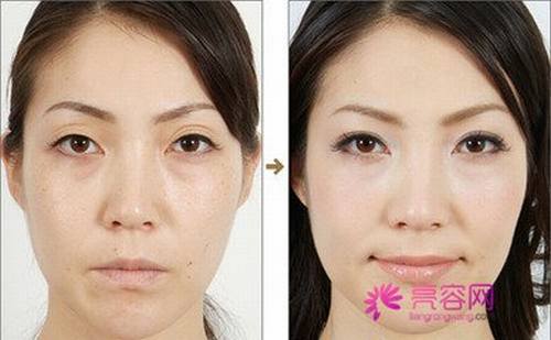 双眼皮失败修复术的价格是多少呢