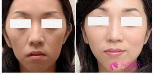 让我们来了解一下丰苹果肌优点有哪些?丰苹果肌术后护理?丰苹果肌多少钱?