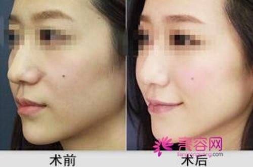 让我们来了解一下丰苹果肌优点有哪些?丰苹果肌术后护理?丰苹果肌多少钱?