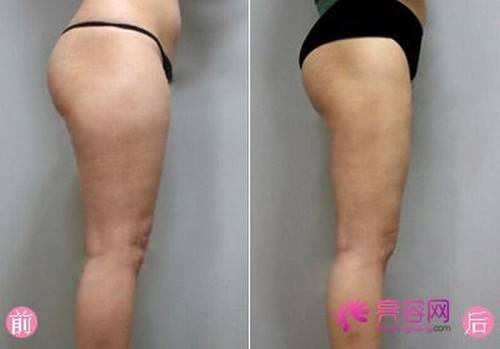 详解大腿吸脂术前准备及术后护理另外吸脂后出现凹凸不平该怎么处理??