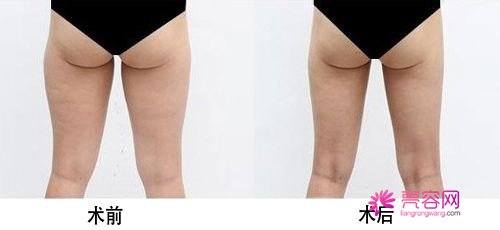 详解大腿吸脂术前准备及术后护理另外吸脂后出现凹凸不平该怎么处理??