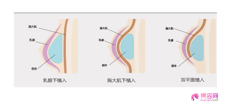 假体隆胸大盘点!(二)大胸妹子请忽略!