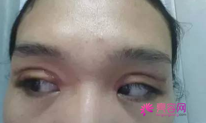 从一台双眼皮失败案例说起：谈谈做双眼皮的利与弊及术后护理！