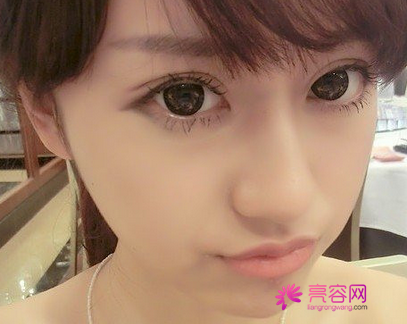 从一台双眼皮失败案例说起:谈谈做双眼皮的利与弊及术后护理!