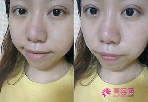 有人问我:埋线双眼皮疼不疼?小编告诉她:仁者见仁,智者见智!