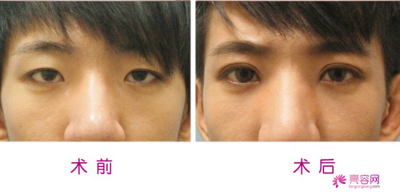 有人问我:埋线双眼皮疼不疼?小编告诉她:仁者见仁,智者见智!
