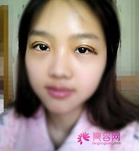 有人问我:埋线双眼皮疼不疼?小编告诉她:仁者见仁,智者见智!