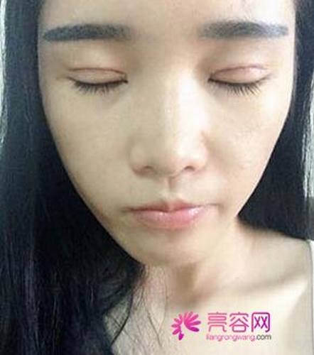 有人问我:埋线双眼皮疼不疼?小编告诉她:仁者见仁,智者见智!