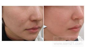 激光嫩肤对比图 激光嫩肤对比图