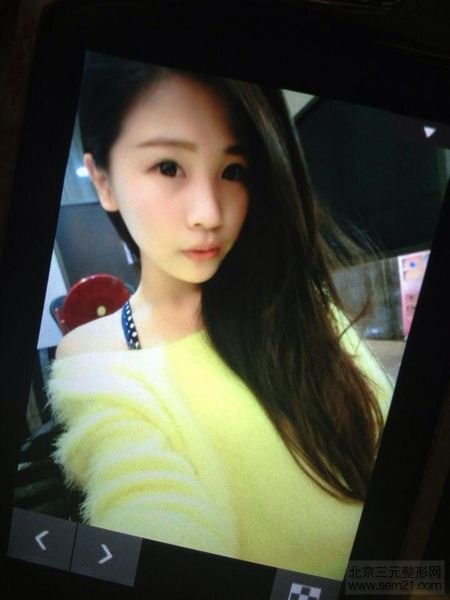 1520726_571480542941946_214426875_n Misko韩式4D隆鼻案例