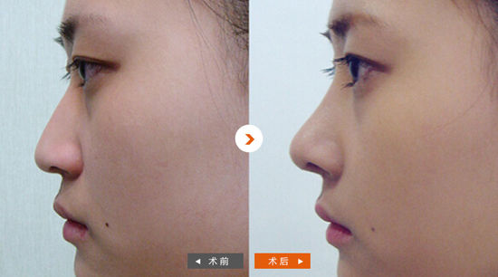 北京八大处金骥隆鼻好吗？多少钱？