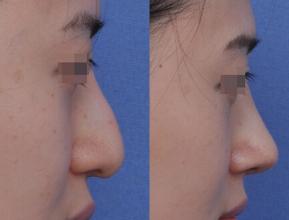 九院王涛隆鼻案例 上海九院王涛隆鼻多少钱?价格贵吗?