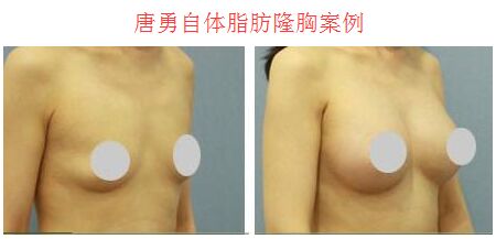 唐勇自体脂肪隆胸案例 唐勇自体脂肪隆胸案例