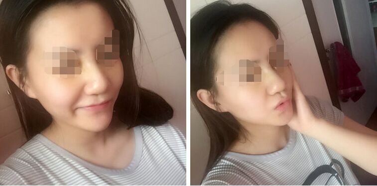 李战强隆鼻案例-李战强隆鼻日记