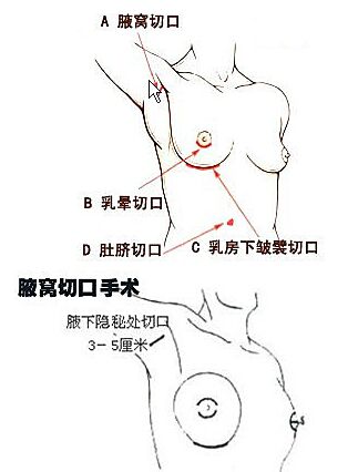 假体隆胸的切口方式有哪些?哪一种好?
