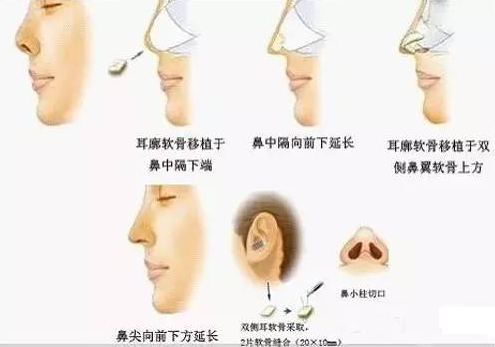 单纯隆鼻能改良朝天鼻吗？