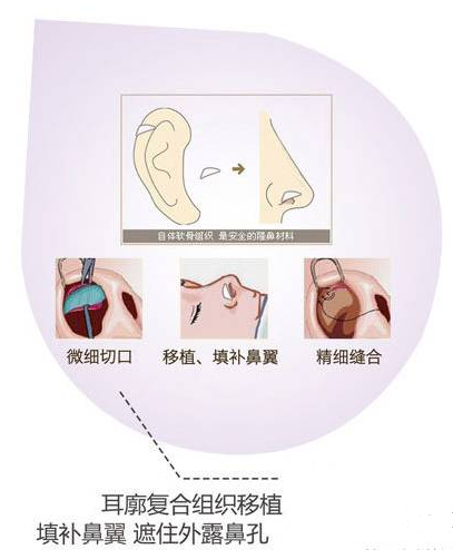 单纯隆鼻能改良朝天鼻吗？