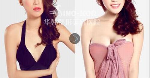 广州美莱高建华丰胸怎么样？多少钱？