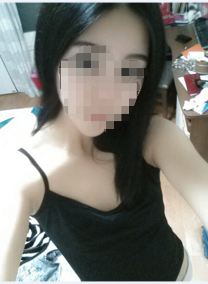 自体脂肪隆胸案例