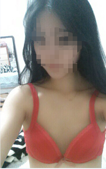 自体脂肪隆胸案例