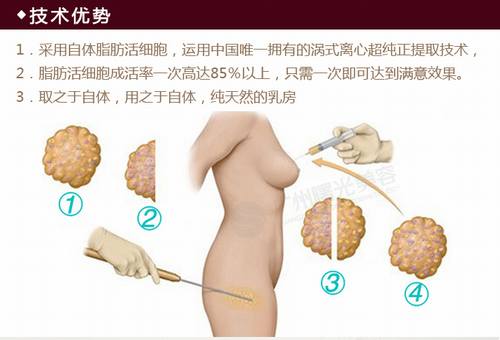 假体隆胸和自体脂肪隆胸