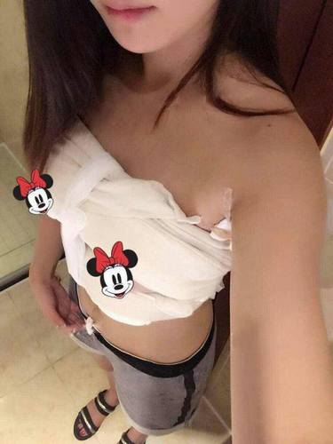 北京玉之光王明利自体脂肪隆胸案例