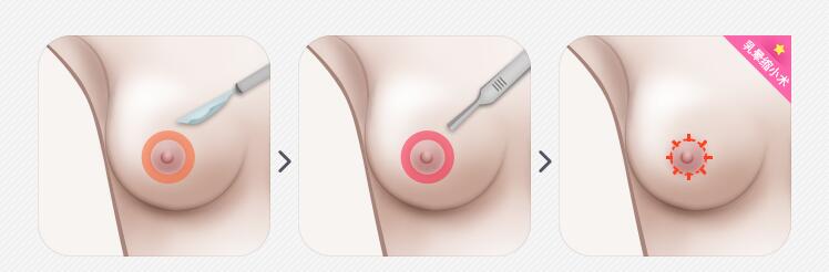 胸部过大的烦恼:乳晕缩小术