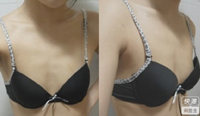 上海玫瑰李鸿君隆胸怎么样？多少钱？案例？