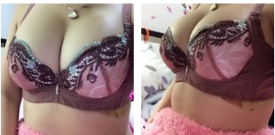 北京禾美嘉任学会自体脂肪隆胸怎么样？多少钱