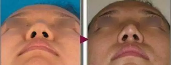 鼻头缩小，男扮女装也可以那么美