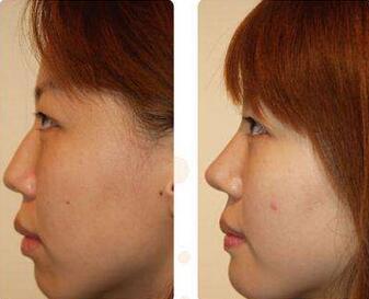 隆鼻后多久能化妆呢?术后小知识