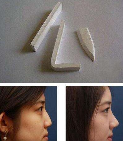 膨体隆鼻的稳定性 膨体隆鼻的稳定性好吗?为什么好?