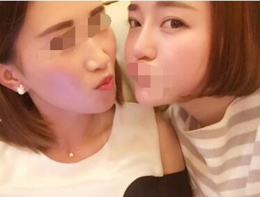 求美者的隆鼻案例!真的美了好多!