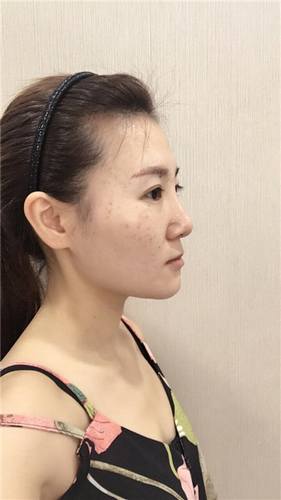 每天福利更新!今日更新的是全脸自体脂肪填充的妹子反馈的真实案例图片分享!来瞧瞧你的自体脂肪做的有咩有她的完美?!小编感觉十分完美!各位拿去羡慕嫉妒吧!不懂欢迎咨询我们哦!
