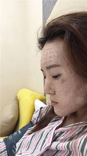 每天福利更新!今日更新的是全脸自体脂肪填充的妹子反馈的真实案例图片分享!来瞧瞧你的自体脂肪做的有咩有她的完美?!小编感觉十分完美!各位拿去羡慕嫉妒吧!不懂欢迎咨询我们哦!