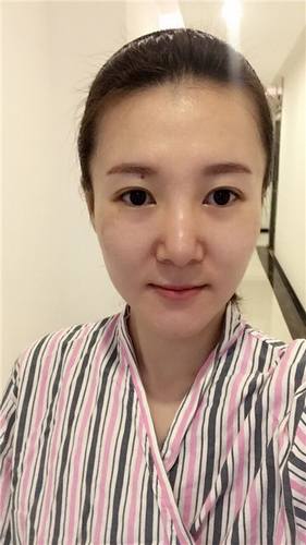 每天福利更新!今日更新的是全脸自体脂肪填充的妹子反馈的真实案例图片分享!来瞧瞧你的自体脂肪做的有咩有她的完美?!小编感觉十分完美!各位拿去羡慕嫉妒吧!不懂欢迎咨询我们哦!