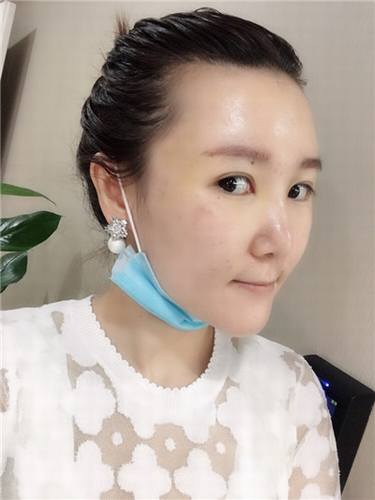 每天福利更新!今日更新的是全脸自体脂肪填充的妹子反馈的真实案例图片分享!来瞧瞧你的自体脂肪做的有咩有她的完美?!小编感觉十分完美!各位拿去羡慕嫉妒吧!不懂欢迎咨询我们哦!