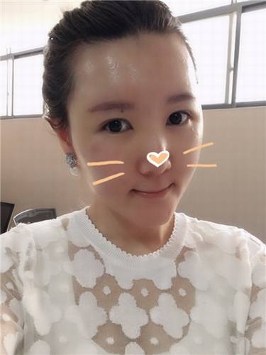 每天福利更新!今日更新的是全脸自体脂肪填充的妹子反馈的真实案例图片分享!来瞧瞧你的自体脂肪做的有咩有她的完美?!小编感觉十分完美!各位拿去羡慕嫉妒吧!不懂欢迎咨询我们哦!