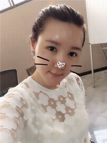 每天福利更新!今日更新的是全脸自体脂肪填充的妹子反馈的真实案例图片分享!来瞧瞧你的自体脂肪做的有咩有她的完美?!小编感觉十分完美!各位拿去羡慕嫉妒吧!不懂欢迎咨询我们哦!
