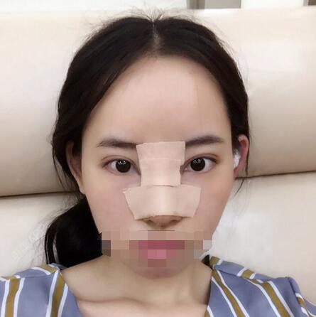 缩小鼻头鼻翼案例 缩小鼻头鼻翼的恢复过程是怎样的?对比图