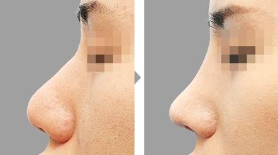 为什么会鼻头肥大?导致鼻头肥大原因是什么