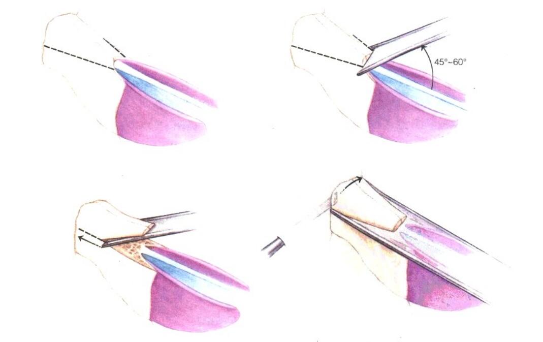 什么是鼻根削底 什么是鼻根削底?专业知识讲解