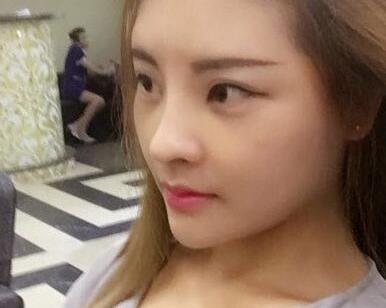 北京沃尔隆鼻案例 什么样的鼻部整形算自然?北京沃尔隆鼻案例