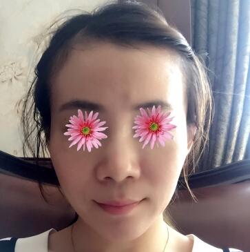 鼻头鼻翼缩小案例 鼻头鼻翼缩小案例