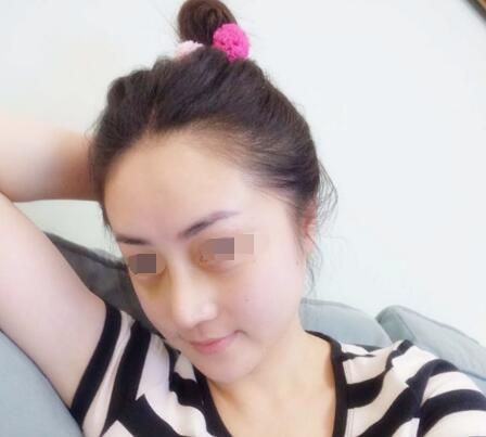 鼻头鼻翼缩小案例 鼻头鼻翼缩小案例